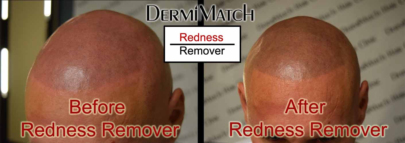 Redness Remover by DermiMatch - Image 2