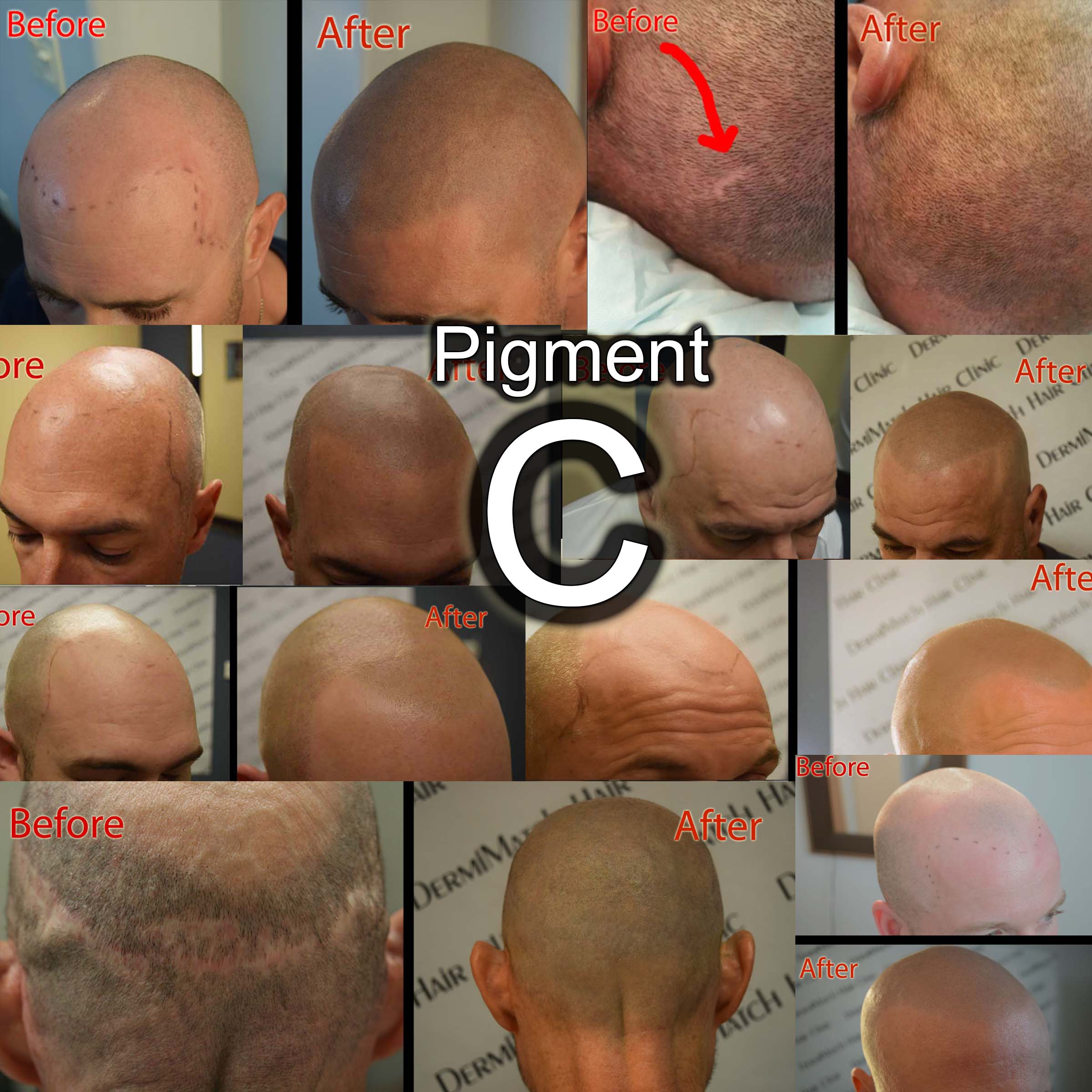 The Complete DermMicro Kit (HD) + Practice Head: For Scalp Micropigmentation Professionals - Image 5